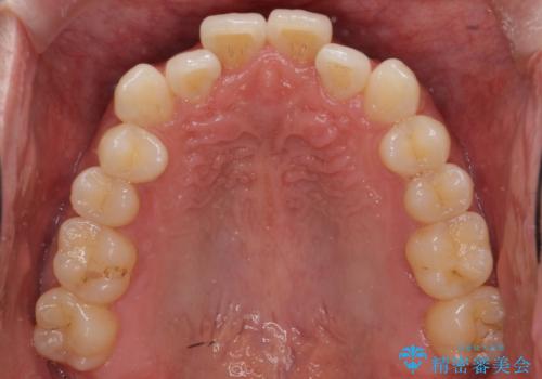 受け口 マウスピースで矯正治療 難易度:中の治療前