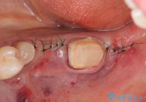 オールセラミッククラウン 欠損補綴と再生療法による深いポケットの改善の治療後