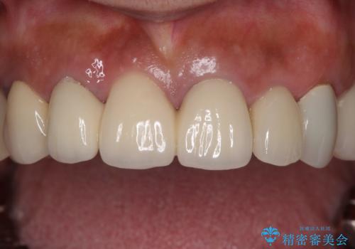 汚れてしまった前歯の仮歯 オールセラミッククラウンにて自然にの症例 治療後