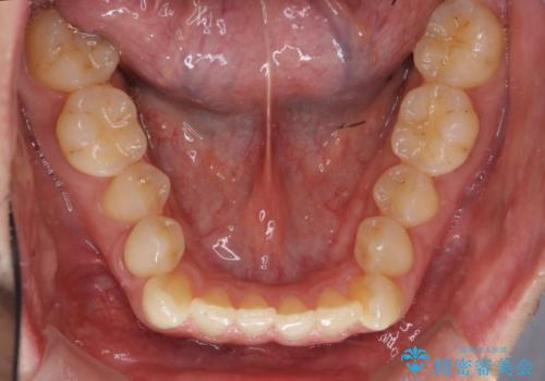 受け口 マウスピースで矯正治療 難易度:中の治療前