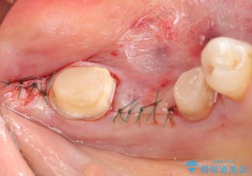 オールセラミッククラウン 欠損補綴と再生療法による深いポケットの改善の治療後