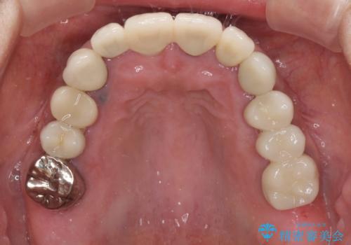 汚れてしまった前歯の仮歯 オールセラミッククラウンにて自然にの治療後