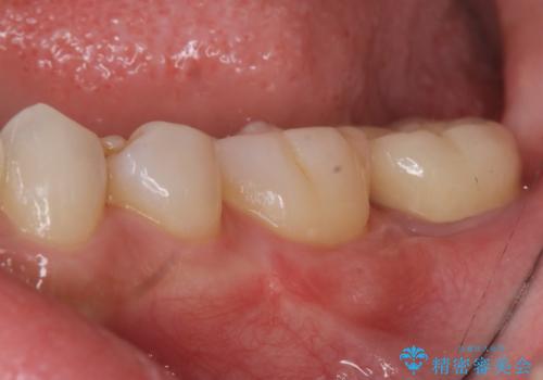 他院で次に虫歯になったら治せないと言われた 歯周外科手術でしっかり治療(APF)の治療後
