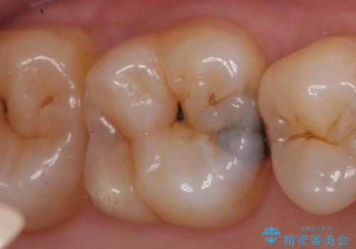 セラミックインレー 痛む歯の治療の治療前