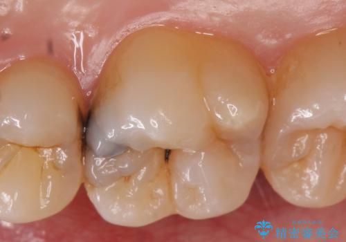 セラミックインレー 痛む歯の治療の治療前