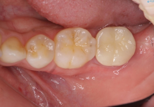 他院で次に虫歯になったら治せないと言われた　歯周外科手術でしっかり治療(APF)の治療後