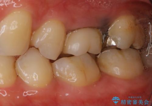 痛みの続いた歯を原因から治療の治療前