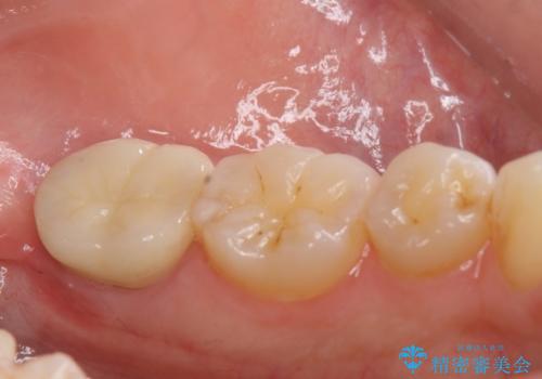 他院で次に虫歯になったら治せないと言われた　歯周外科手術でしっかり治療(APF)の症例 治療後