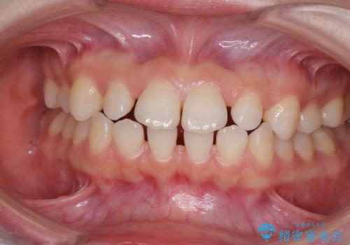 矯正治療とインプラント治療を同時に 総合歯科診療の症例 治療前