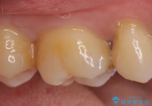 セラミックインレー 痛む歯の治療の治療前