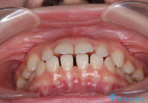 矯正治療とインプラント治療を同時に 総合歯科診療の治療前