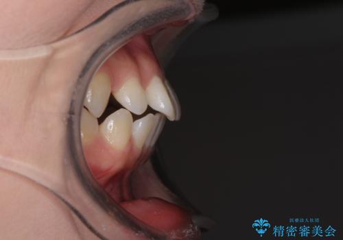 矯正治療とインプラント治療を同時に 総合歯科診療の治療前