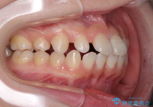 矯正治療とインプラント治療を同時に 総合歯科診療の治療前