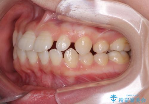 矯正治療とインプラント治療を同時に 総合歯科診療の治療前