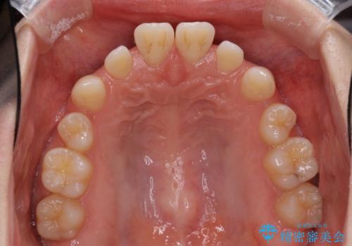 矯正治療とインプラント治療を同時に 総合歯科診療の治療前