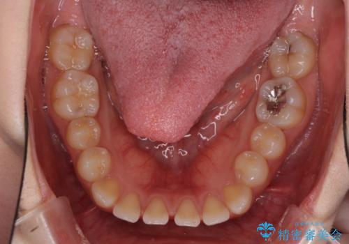 矯正治療とインプラント治療を同時に 総合歯科診療の治療前