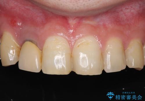 割れてしまった前歯 インプラントによる補綴治療の症例 治療前