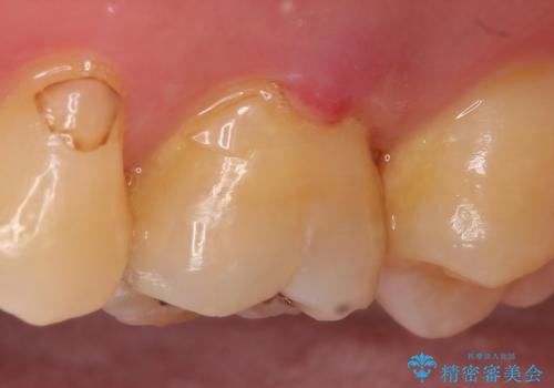 オールセラミッククラウン 精密根管治療~神経が死んでしまった歯の治療~の治療前