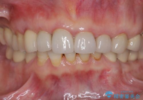 クラウン下に再発した深い虫歯 インプラントによる機能回復の治療後