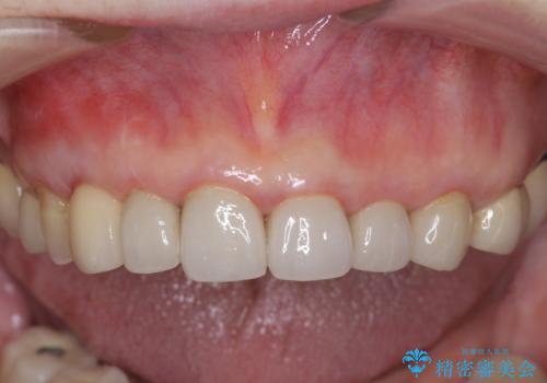 クラウン下に再発した深い虫歯 インプラントによる機能回復の治療後