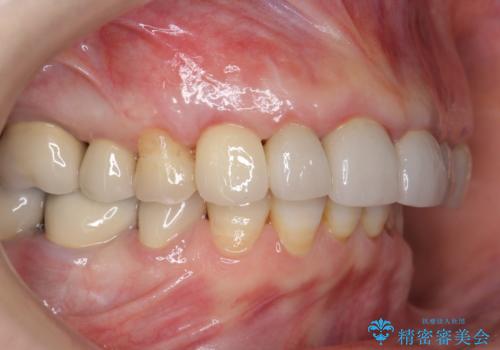 クラウン下に再発した深い虫歯 インプラントによる機能回復の治療後