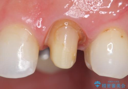オールセラミッククラウン(スペシャル) より綺麗な歯への治療中