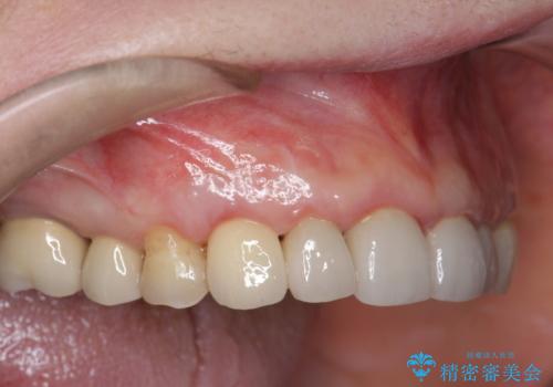 クラウン下に再発した深い虫歯 インプラントによる機能回復の症例 治療後
