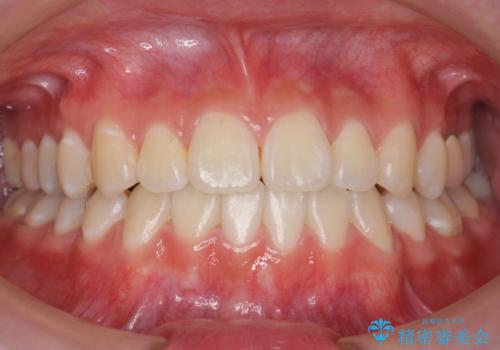 受け口 親知らずを取り込む矯正治療の治療後