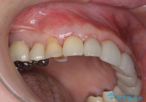クラウン下に再発した深い虫歯　インプラントによる機能回復の治療後
