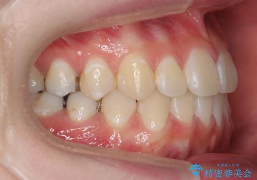 受け口 親知らずを取り込む矯正治療の治療後