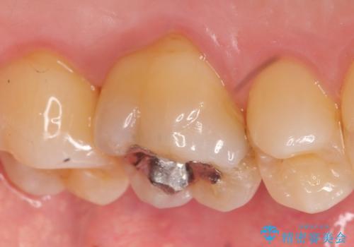 オールセラミッククラウン 精密根管治療~神経が死んでしまった歯の治療~の治療前