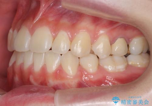 受け口 親知らずを取り込む矯正治療の治療後