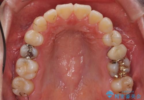 受け口 親知らずを取り込む矯正治療の治療後