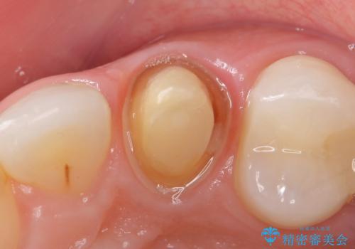 オールセラミッククラウン(スペシャル) より綺麗な歯への治療中
