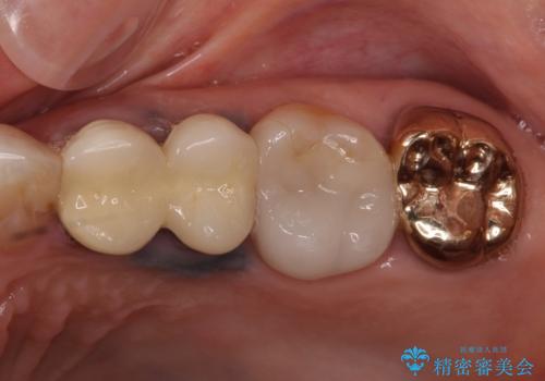 古くなったメタルボンドをオールセラミッククラウンにの症例 治療前