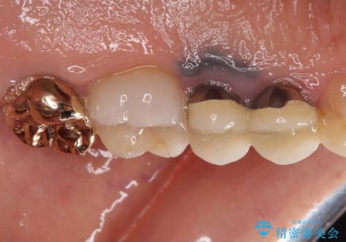 古くなったメタルボンドをオールセラミッククラウンにの治療前