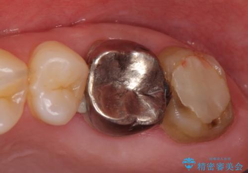 オールセラミッククラウン 疼く奥歯の治療の治療前