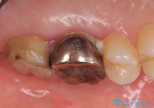 オールセラミッククラウン 疼く奥歯の治療の治療前