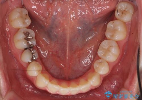 受け口 親知らずを取り込む矯正治療の治療後