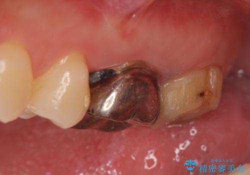 オールセラミッククラウン 疼く奥歯の治療の治療前