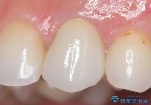 オールセラミッククラウン(スペシャル) より綺麗な歯への治療後