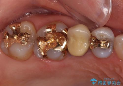 古くなったメタルボンドをオールセラミッククラウンにの治療前