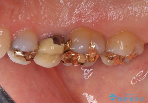 古くなったメタルボンドをオールセラミッククラウンにの治療前