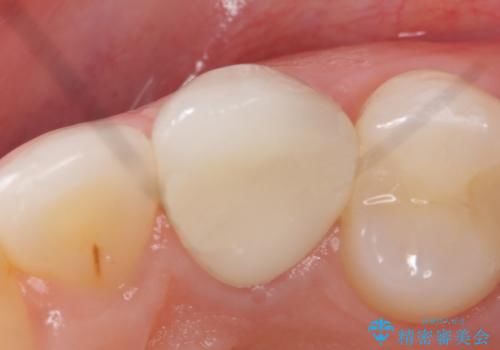 オールセラミッククラウン(スペシャル) より綺麗な歯への治療後