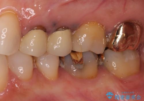 古くなったメタルボンドをオールセラミッククラウンにの治療前