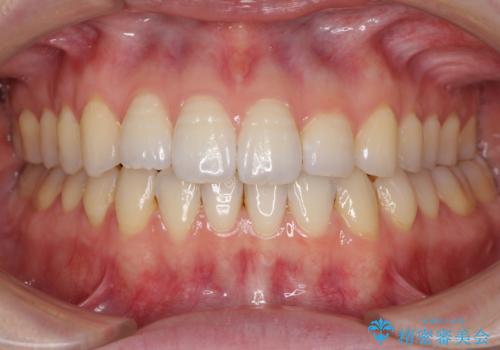 オープンバイトのインビザラインを用いた再矯正 の症例 治療後