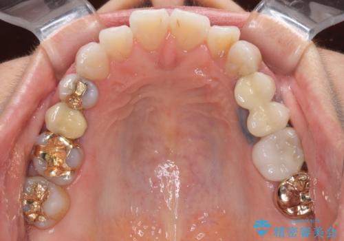 古くなったメタルボンドをオールセラミッククラウンにの治療前