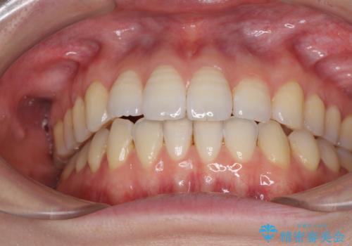 オープンバイトのインビザラインを用いた再矯正 の治療後