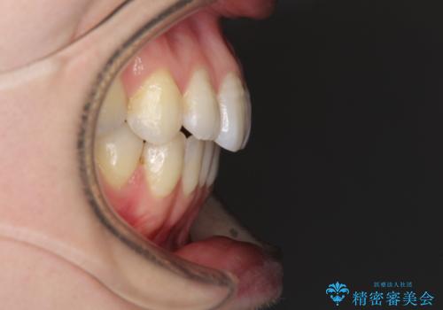 オープンバイトのインビザラインを用いた再矯正 の治療後