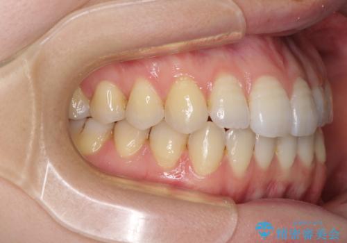 オープンバイトのインビザラインを用いた再矯正 の治療後